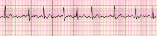 Identify the following rhythm (lead II): ____________________