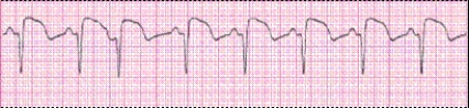 Identify the following rhythm (lead II): ____________________