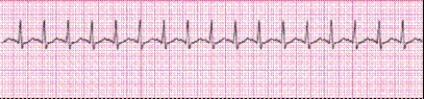 Identify the following rhythm (lead II): ____________________