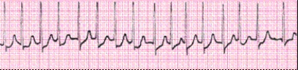 Identify the following rhythm (lead II): ____________________