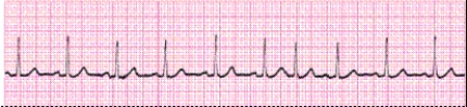 Identify the following rhythm (lead II): ____________________
