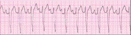 Identify the following rhythm (lead II): ____________________