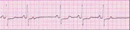 Identify the following rhythm (lead II): ____________________