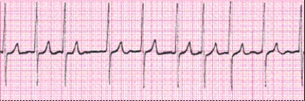 Identify the following rhythm (lead II): ____________________