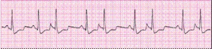 Identify the following rhythm (lead II): ____________________