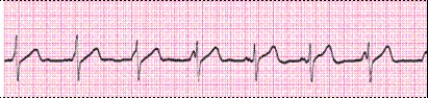 Identify the following rhythm (lead II): ____________________