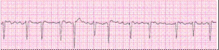 Identify the following rhythm (lead MCL?): ____________________