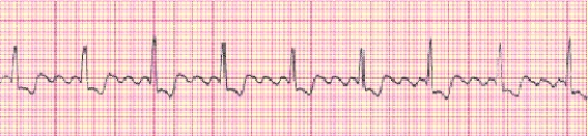 Identify the following rhythm (lead III): ____________________