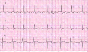 Identify the following rhythm: ____________________