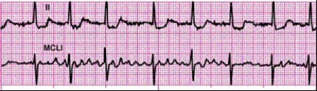Identify the following rhythm: ____________________