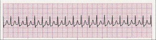 Identify the following rhythm (lead II): ____________________