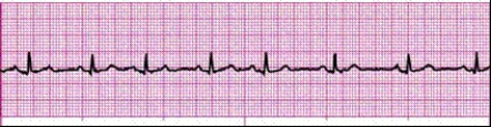 Identify the following rhythm (lead II): ____________________