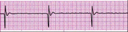 Identify the following rhythm (lead II): ____________________