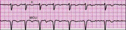 Identify the following rhythm: ____________________