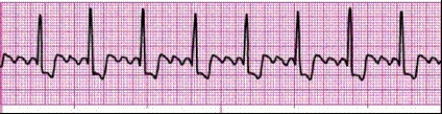 Identify the following rhythm: ____________________