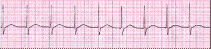 <strong>Identify the following rhythm (lead II). </strong> A) Accelerated junctional rhythm B) Sinus rhythm C) Junctional rhythm D) Sinus arrhythmia