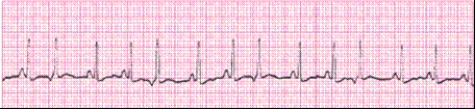 <strong>Identify the following rhythm (lead II). </strong> A) Sinus arrhythmia B) Sinus rhythm with junctional escape beats C) Sinus tachycardia with premature atrial complexes D) Sinus tachycardia with premature junctional complexes