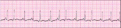 Identify the following rhythm (lead II): ____________________