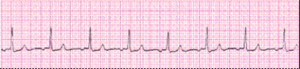 Identify the following rhythm (lead II): ____________________