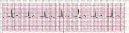Identify the following rhythm (lead II): ____________________