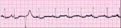 Identify the following rhythm (lead II): ____________________