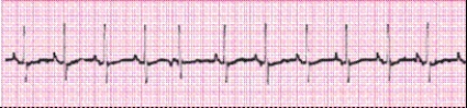 Identify the following rhythm (lead II): ____________________