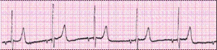 Identify the following rhythm (lead II): ____________________