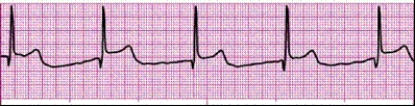 Identify the following rhythm (lead II): ____________________