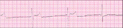 Identify the following rhythm (lead II): ____________________