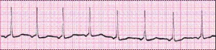 Identify the following rhythm (lead II): ____________________