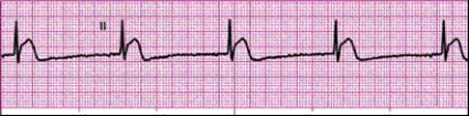 Identify the following rhythm: ____________________