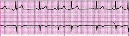 Identify the following rhythm: ____________________