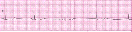 Identify the following rhythm: ____________________