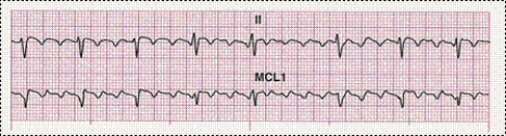 Identify the following rhythm: ____________________