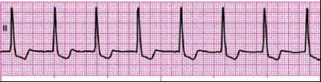 Identify the following rhythm: ____________________