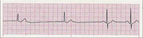 Identify the following rhythm (lead II): ____________________