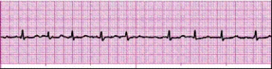 Identify the following rhythm (lead II): ____________________
