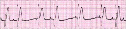 Identify the following rhythm (lead II): ____________________