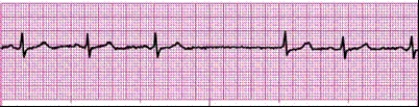 Identify the following rhythm (lead II): ____________________