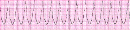 Identify the following rhythm (lead II): ____________________  <div style=padding-top: 35px> 