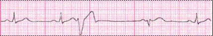 Identify the following rhythm (lead II): ____________________  <div style=padding-top: 35px> 