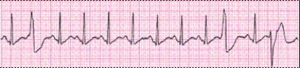 Identify the following rhythm (lead II): ____________________  <div style=padding-top: 35px> 