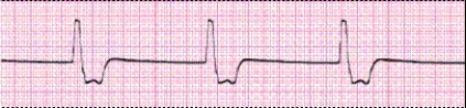 Identify the following rhythm (lead II): ____________________  <div style=padding-top: 35px> 