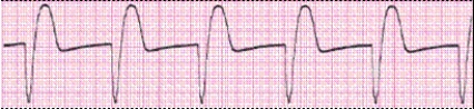 Identify the following rhythm (lead II): ____________________  <div style=padding-top: 35px> 