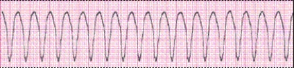 Identify the following rhythm (lead II): ____________________  <div style=padding-top: 35px> 