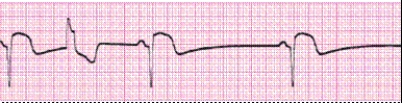 Identify the following rhythm (lead II): ____________________  <div style=padding-top: 35px> 