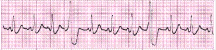 Identify the following rhythm (lead II): ____________________  <div style=padding-top: 35px> 