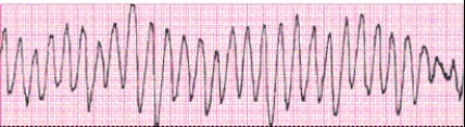 Identify the following rhythm (lead II): ____________________  <div style=padding-top: 35px> 