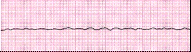 Identify the following rhythm (lead II): ____________________  <div style=padding-top: 35px> 