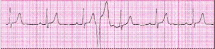 Identify the following rhythm (lead II): ____________________  <div style=padding-top: 35px> 